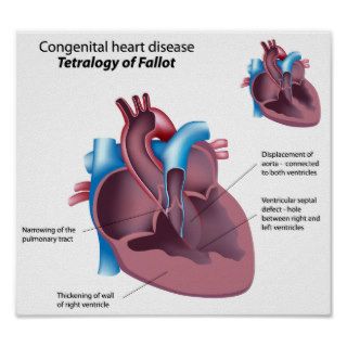 Congenital heart disease Poster