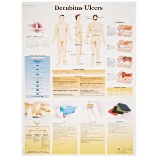 3B Scientific VR1717UU Glossy Paper Decubitus Ulcers Anatomical Chart, Poster Size 20" Width x 26" Height