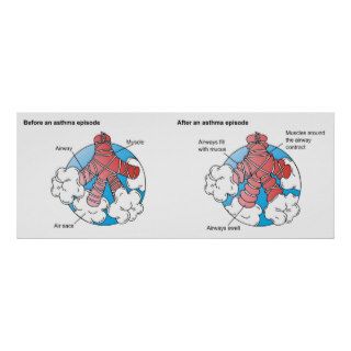 Inflamed Airways Caused by Athsma Before and After Posters