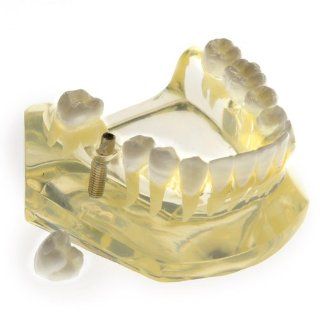 Generic Dental Teeth Study Implant Model 2010I Health & Personal Care