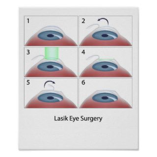 Lasik eye surgery procedure Poster